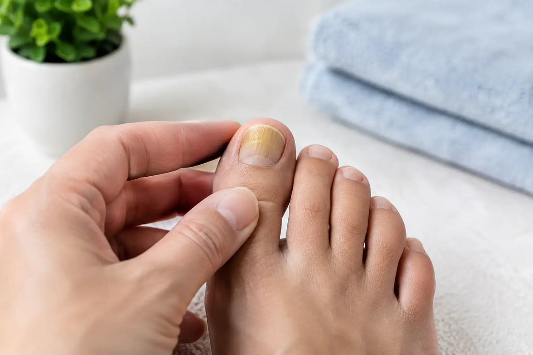 When Are Fungal Nails Serious? Signs to Act