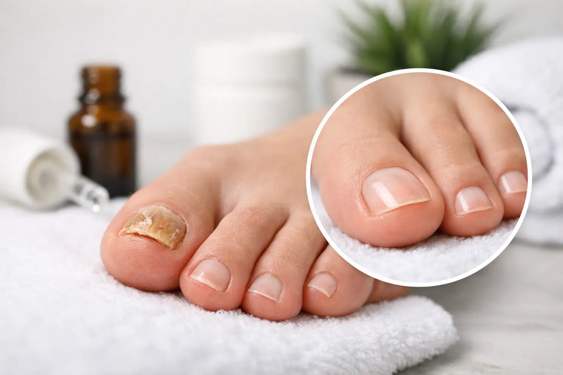One Nail Fungus Treatment Success Story in 90 Days