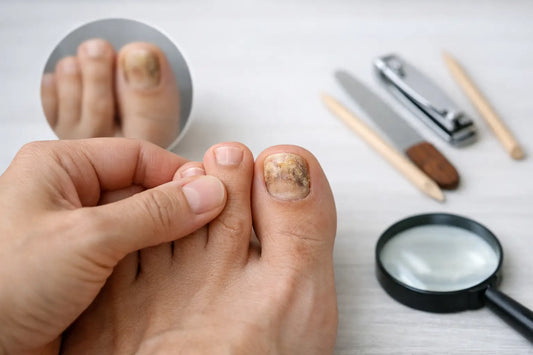 Why Does Nail Fungus Keep Coming Back Again?