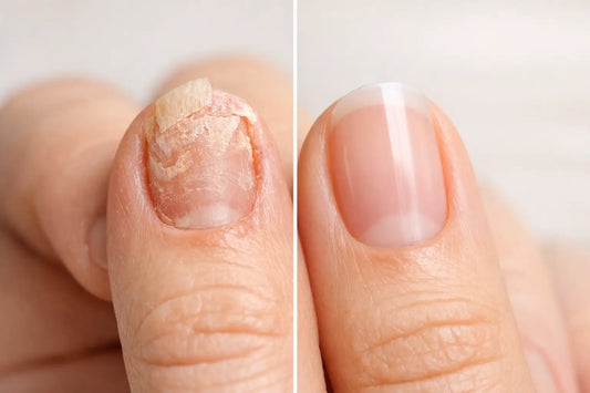 Before After Damaged Nail Regrowth Results