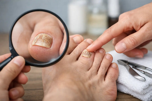 Nail Fungus Symptoms Guide for Early Signs